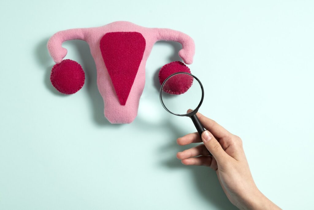 representação meramente ilustrativa da síndrome do ovário policístico (SOP)